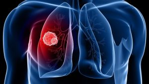 Lung-Cancer-3